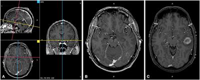 Predictive Value of Temporal Muscle Thickness Measurements on Cranial Magnetic Resonance Images in the Prognosis of Patients With Primary Glioblastoma